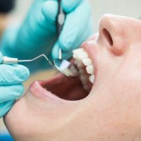 Is it possible to reverse tooth decay?