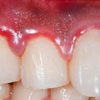 What Happens When Dentists Don’t Diagnose Gum Disease?