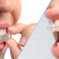 The Invisalign Revolution: Is It Really Better Than Traditional Metal Braces?